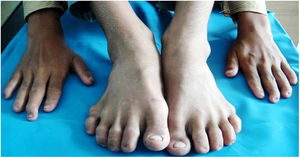 Ausencia total de las uñas del 5.° dedo del pie.