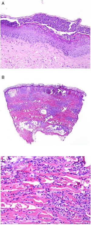 A)Infiltrado neutrofílico preferentemente epidérmico en la pustulosis exantemática generalizada (H&E ×100). B)Infiltado difuso dérmico rico en polimorfonucleares neutrófilos maduros con intenso edema subdérmico y áreas de hemorragia en dermis papilar (H&E ×20). C)A este aumento, los polimorfonucleares neutrófilos, así como la cariorrexis, se ven con mayor detalle (H&E ×200).