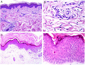 A)Biopsia de un rash evanescente de una enfermedad de Still mostrando un infiltrado inflamatorio perivascular superficial linfohistiocitario (H&E ×100) con algunos neutrófilos (B: H&E ×400). C)En las biopsias de enfermedad de Still crónica sigue siendo evidente un infiltrado inflamatorio perivascular superficial con algunos neutrófilos (H&E ×100), pero se observan además queratinocitos necróticos en las partes altas de la epidermis (D: H&E ×400).