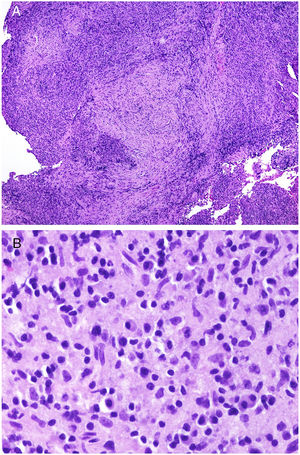 A)A bajo aumento, la enfermedad IgG4-relacionada debe sospecharse por la coexistencia de un infiltrado rico en células plasmáticas con áreas de fibrosis concéntrica (H&E ×40). B)Infiltrado rico en células plasmáticas en un caso de enfermedad IgG4-relacionada (H&E ×400).