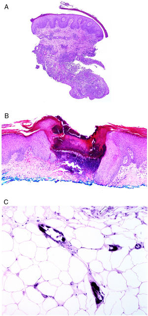 A)Trayecto fistuloso en la biopsia de una lesión de Crohn «metastásico» en pierna (H&E ×20). B)Colagenosis perforante con eliminación de fibras eosinofílicas de colágeno por un cráter de material necrótico (H&E ×20). C)Calcifilaxis mostrando las paredes calcificadas de vasos subcutáneos de calibre pequeño (H&E ×200).