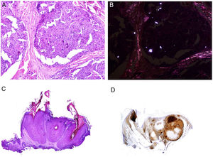 A)Reacción granulomatosa epitelioide sarcoidea en la dermis en un caso de granuloma por sílice (H&E ×100). B)En el examen de los granulomas sarcoideos con luz polarizada se observan numerosas partículas intensamente birrefringentes (H&E ×100, luz polarizada). C)Ejemplo típico de un tricolemoma (H&E ×20); incluso a este aumento se pueden ver las vacuolizaciones citoplásmicas celulares características. D)Preservación de la expresión de PTEN en un tricolemoma esporádico, no asociado a síndrome de Cowden (PTEN ×20).