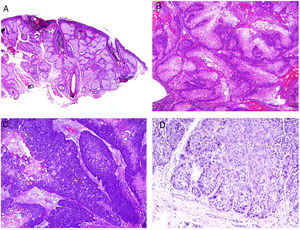 A)Hiperplasia sebácea (H&E ×20). Neoplasias sebáceas asociadas al SMT: B)adenoma sebáceo (H&E ×40); C)sebaceoma (H&E ×40), y D)carcinoma sebáceo (H&E ×200).
