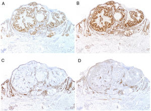 Estudio inmunohistoquímico de marcadores de reparación del ADN en un adenoma sebáceo asociado a síndrome de Muir-Torre, demostrando preservación de la expresión de PMS2 (A: ×20) y MLH1 (B: ×20) con pérdida de la expresión de MSH2 (C: ×20) y MSH6 (D: ×20).