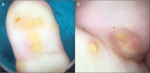 a) Evaluación dermatoscópica de pápulas en las palmas: patrón amarillo sin estructura y un borde hiperqueratósico periférico; b) asterisco: nubes de depósitos amarillos más claros, vasos lineales y un borde hiperqueratósico periférico.