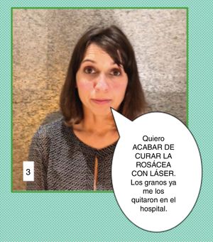 Caso clínico 3 de comunicación en estética. Este caso presenta varios retos: la paciente quiere curarse de una enfermedad crónica y además, parece que es lo que ha entendido que le han dicho cuando ha sido tratada en el hospital. Debemos aclarar conceptos con paciencia, explicándole lo que es la rosácea y lo que buscamos con la luz del láser, así como que precisará un mantenimiento. Es decir, mucho ajuste de expectativas.