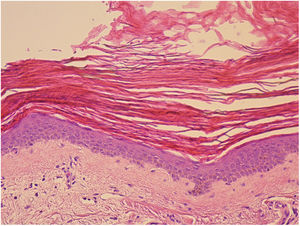 Histopatología de una de las lesiones. Se observa hiperqueratosis compacta y ortoqueratósica, adelgazamiento de la capa granulosa y ligera espongiosis. Ligero infiltrado linfocitario en dermis papilar, sin otras alteraciones dérmicas (H&E x20).