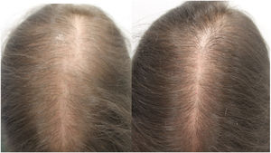 A) Mujer de 33 años con alopecia androgénica femenina antes del inicio del tratamiento con minoxidil oral 1mg/día. B) A los 12 meses de tratamiento.