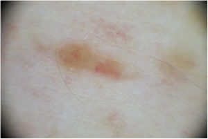 Imagen dermatoscópica, coloración amarillo-anaranjada homogénea con vasos lineales en su interior.