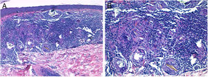 Imágenes histopatológicas. A)En dermis superficial, infiltrado granulomatoso no necrosante (hematoxilina-eosina, ×10). B)Histiocitos epitelioides y material cristalino birrefringente fagocitado por células gigantes multinucleadas (hematoxilina-eosina, ×20).