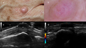 a) Nódulo de color piel situado en el dorso de la mano a nivel de la articulación metacarpofalángica; b) Imagen dermatoscopia de la lesión (a). Se observa un fondo color piel y estructuras inespecíficas como crisálidas y vasos irregulares mal enfocados; c) Imagen ecográfica de la lesión (a). Se observa un nódulo hipoecoico bien definido situado en dermis profunda; d) Imagen ecográfica de la lesión (a). No se demuestra actividad power Doppler.