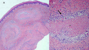 a) Imagen panorámica que muestra granulomas situados en la dermis profunda (hematoxilina-eosina, ×20); b) Detalle de la imagen (a), donde se observan granulomas compuestos de histiocitos en empalizada (flecha) dispuestos alrededor de una zona central eosinófila que se corresponde a fibirina (asterisco) (hematoxilina-eosina, ×100).