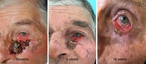 Regresión clínica del carcinoma basocelular en el párpado inferior izquierdo durante la terapia con vismodegib.