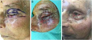 Etapas intraoperatorias con escisión de la lesión residual sospechada en el párpado inferior y reconstrucción con un colgajo de Tripier modificado del párpado superior (A, B) y resultado posquirúrgico a los 6 meses (C).