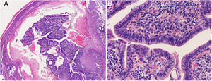 Hematoxilina-eosina: A) ×20, B) ×40.