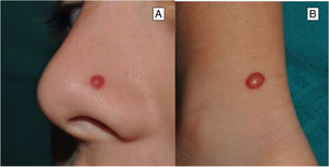 Características clínicas del nevo de Spitz clásico. A y B) Lesión tumoral rojiza, bien delimitada, cupuliforme, localizada típicamente en la región facial o en las extremidades inferiores.