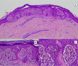 Nevo de Spitz intraepidérmico. Aunque la mayoría de los NS son compuestos, una pequeña proporción de ellos pueden estar limitados a la unión dermoepidérmica. Las características citológicas, no obstante, son similares a las del NS compuesto. A) A poco aumento destaca una lesión intraepidérmica compuesta por grandes tecas de células névicas fusiformes. B) y C) A mayor aumento puede apreciarse la celularidad fusocelular sin atipia y con escaso pigmento melánico citoplasmático, así como la presencia de cuerpos de Kamino.