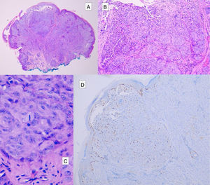 Tumor spitzoide. A) Proliferación de melanocitos epitelioides que muestra una zona nodular central, que contiene melanocitos atípicos (B) y frecuentes mitosis (C). La zona nodular central presenta una expresión aumentada de Ki67 (D).