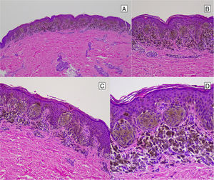 Nevo de Reed. A) Proliferación de células névicas fusiformes sin atipias dispuestas en tecas en la unión dermoepidérmica. B), C) y D) Muestran ausencia de atipia y abundante pigmento melánico intracitoplasmático y melanófagos dérmicos.