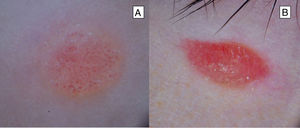 Patrones dermatoscópicos del nevo de Spitz clásico. A) Patrón vascular con presencia de vasos puntiformes, monomorfos, distribuidos regularmente sobre un fondo rosado. B) Patrón vascular rosado homogéneo que muestra una tonalidad rosada en ausencia de otras estructuras.