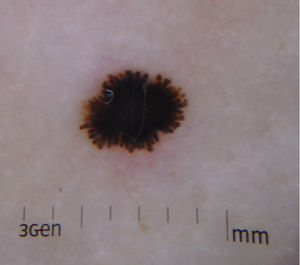 Patrón dermatoscópico del nevo de Reed. Patrón en estallido de estrellas en el que se observa una pigmentación negra, homogénea, central y proyecciones radiales regulares en la periferia.