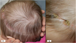 Características clínicas. Placa de alopecia anular (a). Detalle de las costras sobre la placa alopécica (b).