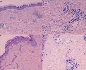 Biopsias cutáneas (hematoxilina-eoxina) de las pacientes 1 (a, b) y 2 (c, d); a, c (40×). Dilatación de los vasos dérmicos superficiales, con un discreto edema dérmico e infiltrado inflamatorio perivascular, sin presentar vasculitis, proliferación capilar ni extravasación eritrocitaria; b, d (200x). Células endoteliales que protruyen hacia el espacio vascular junto al infiltrado perivascular.
