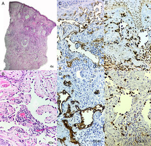 A) Vista panorámica del tumor extendiéndose a través de la dermis. B) El tumor compuesto por vasos finos tapizados por células endoteliales atípicas en su cara luminal. C-F) Inmunohistoquímica mostrando la diferenciación vascular y endotelial, así como un elevado índice proliferativo.