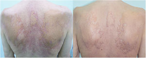 Pápulas agrupadas de color amarillo anaranjado sobre una base eritematosa que se asemejan a xantomas, acompañadas por pápulas eritematosas y localizadas en el tronco. Tras la fototerapia las pápulas eritematosas y las erosiones desaparecieron, objetivándose también un aclaramiento de las placas amarillo-anaranjadas.