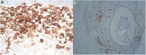 La inmunohistoquímica demostró la expresión de CD1a (3a) y CD207 (3b) en las células con un citoplasma eosinófilo y núcleos lobulados o con hendidura.