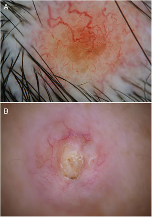 A) Vasos telangiectásicos sobre fondo anaranjado y pigmentación marrón periférica. B) Telangiectasias arboriformes periféricas y área central amarillenta.