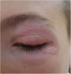 Tinea faciei en un niño de 9 años. Nótese el componente inflamatorio, con micropústulas.