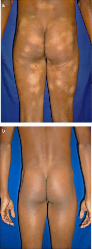 Máculas hipopigmentadas en zonas no fotoexpuestas. En esta serie, la variante hipopigmentada fue la forma más frecuente de la micosis fungoide. A) Antes de iniciar tratamiento. B) Posterior a PUVA.