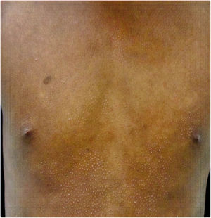 Micosis fungoide tipo liquen espinuloso.