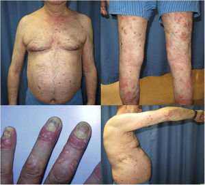 Placas eritematosas y con descamación gruesa moderadamente infiltradas en tronco, extremidades superiores e inferiores. Inflamación periungueal con afectación ungueal en forma de traquioniquia, hiperqueratosis, manchas de aceite y onicólisis.
