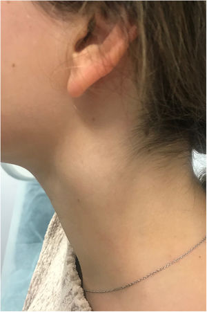 Abultamiento en la región cervical izquierda, obsérvese la ausencia de afectación en la superficie cutánea.