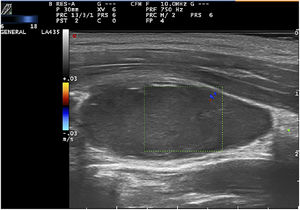 Modo Doppler color, corte longitudinal, ausencia de flujo intralesional.