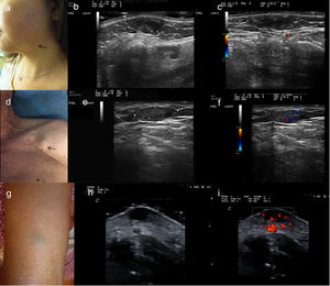 a) Caso 1: presentación clínica en forma de nódulo subcutáneo de 10mm diámetro con superficie azulada, localizado en la región mandibular izquierda. b) Examen ecográfico en modo B. Lesión hipoecoica bien definida, homogénea localizada en dermis con puntos hiperecoicos sin sombre acústica posterior. c) Examen ecográfico modo Doppler color. Mínimas áreas vasculares localizadas en el interior de la lesión. d) Caso 2: presentación clínica en forma de masa subcutánea de 20mm de diámetro, sin alteraciones epidérmicas, localizada en región pectoral derecha. e) Examen ecográfico modo Doppler color. Lesión hipoecoica, homogénea, bien delimitada, localizada en tejido celular subcutáneo. f) Examen ecográfico modo Doppler color. Vascularización moderada en el interior de la lesión. g) Caso 3: presentación clínica. Lesión subcutánea de 1cm de diámetro con la epidermis suprayacente ligeramente verde-azulada. h) Examen ecográfico en modo B. Lesión hipoecoica localizada en dermis, bien delimitada. i) Examen ecográfico modo Doppler color. Vascularización intralesional y perilesional prominente.
