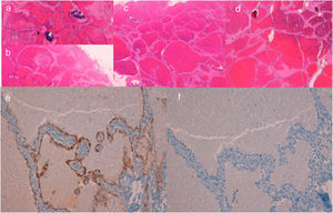 a y b) Caso 1: calcificación focal en el interior de la lesión, observándose también trombosis intravascular (HE×40). c) Caso 2: masa bien circunscrita, lobulada, compuesta por múltiples canales vasculares dilatados e interconectados entre sí, con pared vascular fina, formando estructuras sinusoidales (HE×40). d) Caso 3: canales vasculares dilatados interconectados entre sí formando un patrón sinusoidal, sin observarse calcificaciones ni trombos (HE×40). e) Inmunohistoquímica del caso 2 para WT1×200. f) Inmunohistoquímica del caso 2 para D2-40×200.