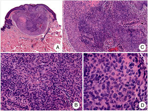 Tumoración nodular superficial, circunscrita (A), constituida por células fusiformes y epitelioides de núcleos ovales o redondeados sin atipia significativa (B,C) y límites imprecisos (D) (H-E: A, ×40; B, ×100; C, ×200; D, ×400).