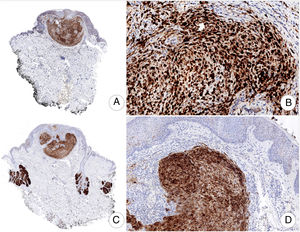 Inmunotinción difusa para S-100 (A,B) y EMA (A-D) (A, ×10; B, ×200; C, ×10; D, ×100).