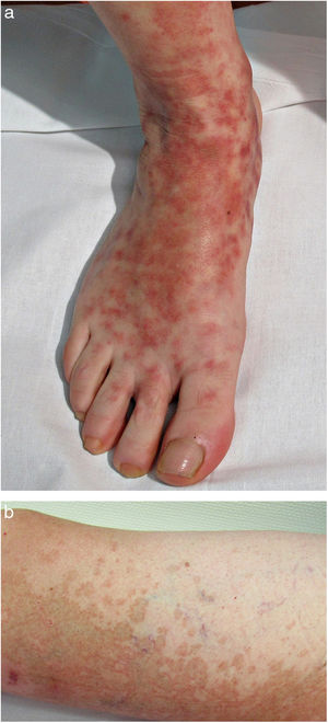 Enfermedad de Schamberg. a) Máculas rojo-anaranjadas con tendencia a confluir formando grandes placas. b) Punteado en granos de pimienta de cayena en periferia.