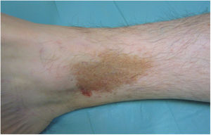 Liquen aureus. Lesión única en extremidad inferior en forma de placa formada por la confluencia de pequeñas máculas amarillo-anaranjadas.