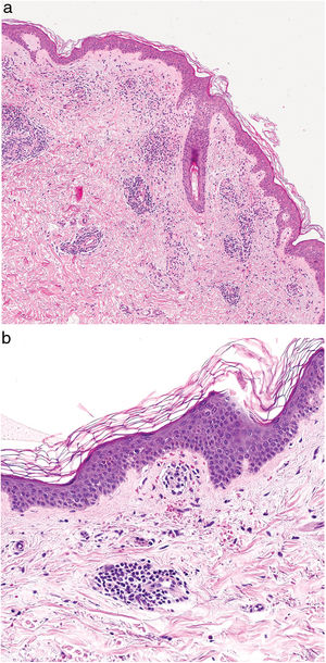 Imagen histopatológica de enfermedad de Schamberg. a) Infiltrado localizado a nivel de los vasos de pequeño calibre en dermis superficial. b) Infiltrado linfohistiocitario, con estrechamiento de las luces vasculares, y extravasación de hematíes.