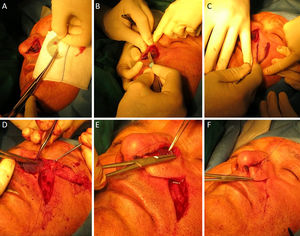 A) Diseño y recorte de la malla de titanio en función al tamaño del defecto final. B) Incisión paralela a la piel en el tejido celular subcutáneo de piel sana circundante al defecto, labrando un «bolsillo» para la posterior colocación de la malla de titanio. C) Incisión de colgajo melolabial. D) Fijación de malla de titanio con sutura reabsorbible de 4/0. E) Inicio de sutura de colgajo melolabial plegado sobre malla de titanio por su extremo distal (constituyendo la cara interna de la pared nasal. F) Sutura externa del colgajo mediante seda de 4/0.