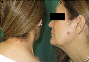 En la región cervical posterior (a) y en la mejilla izquierda (b) sendas pápulas eritematosas cupuliformes, infiltradas y de consistencia firme.