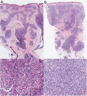 En la lesión cervical (a) y en la lesión de mejilla izquierda (b), infiltrado linfohistiocitario en dermis e hipodermis con tropismo por anejos y ausencia de epidermotropismo (H&E ×2). En la lesión cervical (c) y en la lesión de mejilla izquierda (d), infiltrado compuesto por células pleomórficas con atipia leve-moderada (H&E ×20).