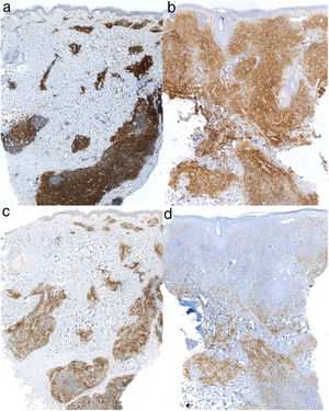 Inmunohistoquímica con positividad para CD4 (×2) en la lesión cervical (a) y en la lesión de mejilla izquierda (b). Inmunohistoquímica con positividad para PD-1 (×2) en la lesión cervical (c) y en la lesión de mejilla izquierda (d).
