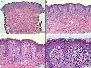 a) Hematoxilina eosina x40. b) Hematoxilina eosina x100. c) Hematoxilina eosina x200. d) Hematoxilina eosina x400.