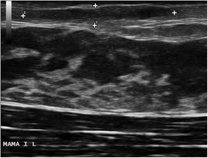 Ecografía de la lesión que muestra una imagen longitudinal en banda en la dermis superficial hipoecogénica de 15×2,4×6mm, doppler negativa, compatible con trayecto fistuloso.